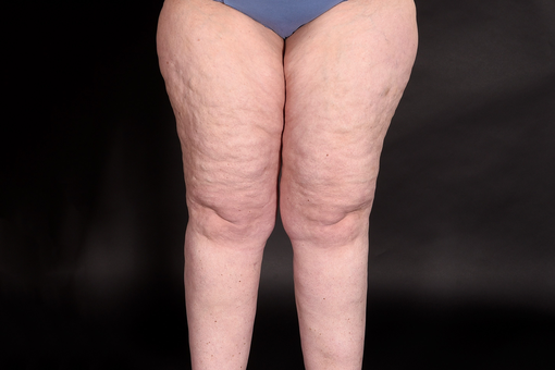 Close-up al picioarelor superioare lărgite ale unei persoane cu pielea îndoită's enlarged upper legs with dimpled skin