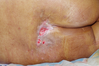 A pressure ulcer on brown skin. There are dark purple patches with red and pink areas in the middle.