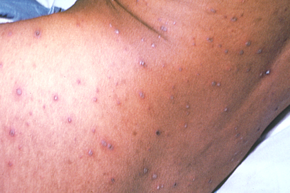 Stage 3 of chickenpox on medium brown skin with pink, purple and grey scabs. A long description is available next.