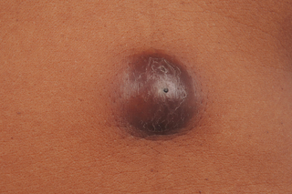 A dark brown lump (an infected skin cyst) on a person with medium brown skin. There is a small, black spot in the middle of the lump.