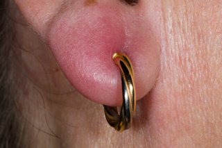 Close-up photo of a person's ear lobe with a gold hoop earring. The ear lobe is red and swollen.
