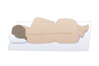 A person lying on their side for a lumbar puncture