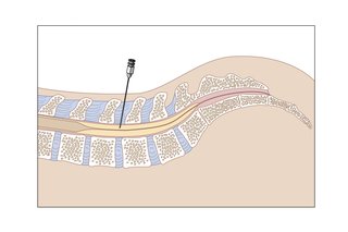 A needle going into the spine for a lumbar puncture