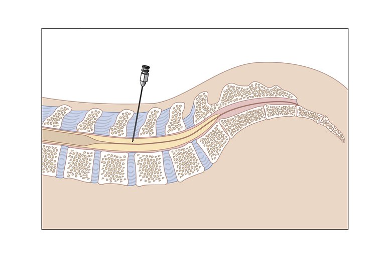 What Is A Lumbar Puncture Called