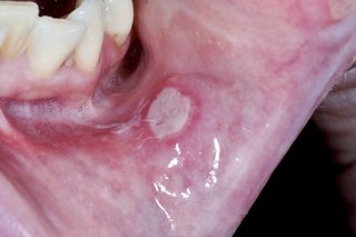 A large, white, circular mouth ulcer on the inside of the bottom lip.