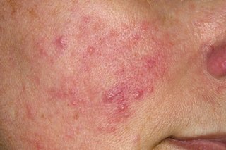 Picture of pink and red bumps with some bumps filled with a yellowish liquid on the cheek of a woman with white skin.