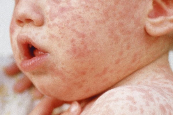 A red, spotty rash on a child's face and shoulder, caused by measles. Shown on white skin.