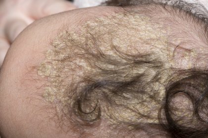 Pale yellow cradle cap crusts on the scalp of a baby with white skin. A long description is available next.