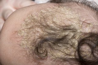 Image of cradle cap crusts on a baby's head.