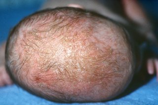 Cradle cap in a baby with white skin. The top of the baby’s head is covered with greasy yellow or brown scales and the surrounding area is red.