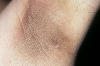 A dark patch of skin on the armpit of a person with white skin. The patch covers most of the person's armpit.