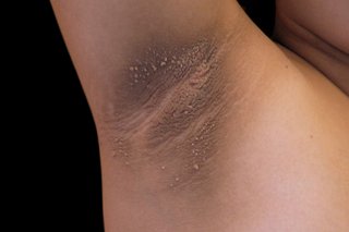 Dark patches of skin covering the armpit of someone with medium brown skin. There are also about 50 small skin tags.