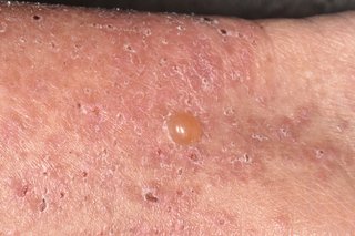 Close-up of pinkish-brown, flaky, dry rash with scabs and a small orange blister. Shown on white skin.