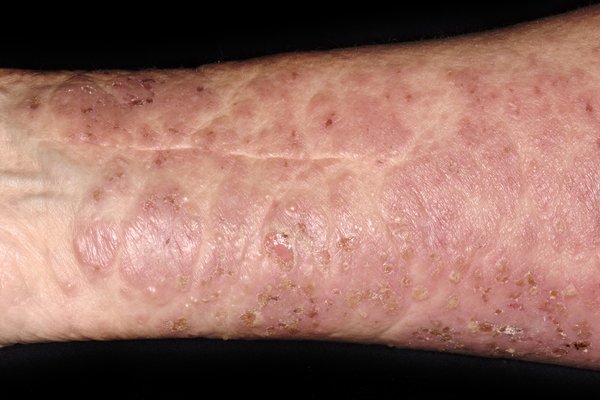 Large scaley, pink rash with small scabs on the arm of a person with white skin.