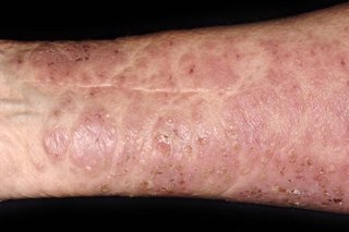 Large scaley, pink rash with small scabs on the arm of a person with white skin.