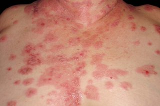 Sore, red patches with small blisters spreading across a person's chest and neck. Shown on white skin