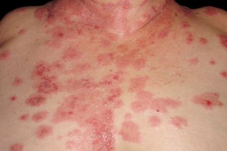 Sore, red patches with small blisters spreading across a person's chest and neck. Shown on white skin