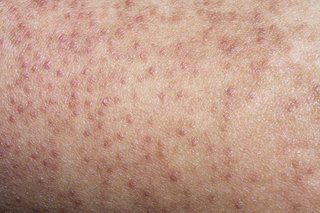 Small bumps close together on white skin. The bumps are darker than the skin colour.