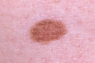 A harmless, flat, brown mole on pink skin.