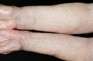 The inside of 2 white arms, from wrist to elbow. 1 arm is swollen, so it looks much bigger and the skin is stretched tight.
