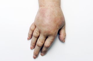 A swollen white hand that looks puffy. The skin is stretched and shiny, especially across the top of the hand and knuckles.