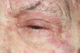 Shingles shown on white skin. Close up of a person's face with a red, swollen eyelid and a red rash on surrounding skin.