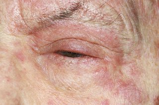 Shingles shown on white skin. Close up of a person's face with a red, swollen eyelid and a red rash on surrounding skin.