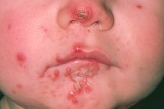 The lower half of a child's face with red and yellow weepy sores on the nose and around the mouth caused by impetigo. Shown on white skin.