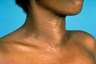 An egg-shaped lump on the lower front of a woman's neck.