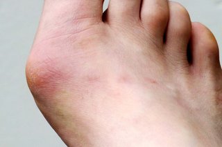 Bunion on right foot shown on white skin. The bunion appears swollen and red.