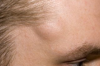 A lipoma under the skin of the forehead of someone with white skin. The lipoma is a few centimetres wide.