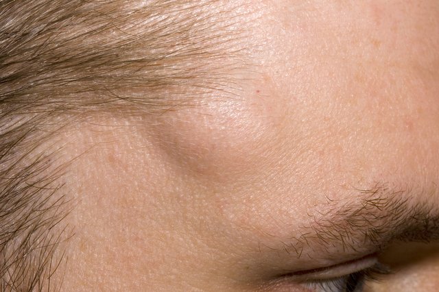 Hard Lump Under Skin On Forehead