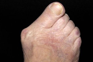 A bunion on a person's right foot. All the toes are pointing at a 45 degree angle to the right.