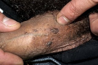 A number of dark brown lumps on the skin of a person's penis. Shown on medium brown skin.