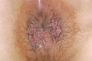 Two clusters of small, pink growths on either side of a person’s anus. The image shown is on white skin.