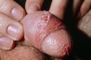 A penis with the foreskin being pulled back. There is a cluster of pink, fleshy growths on the person’s foreskin. The image shown is on white skin.