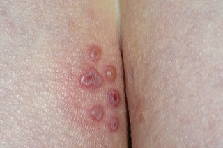 A group of small white blisters that are pink around the edge, including burst ones, on the buttocks. Shown on white skin.