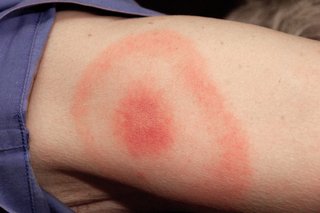 A typical Lyme disease rash on white skin. There is a round, red area, surrounded by a red, ring-shaped rash.
