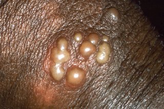 A group of small blisters on the shaft of a penis