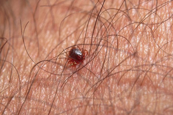 A close-up image of a red-brown tick on skin, surrounded by brown hairs. Shown on white skin..