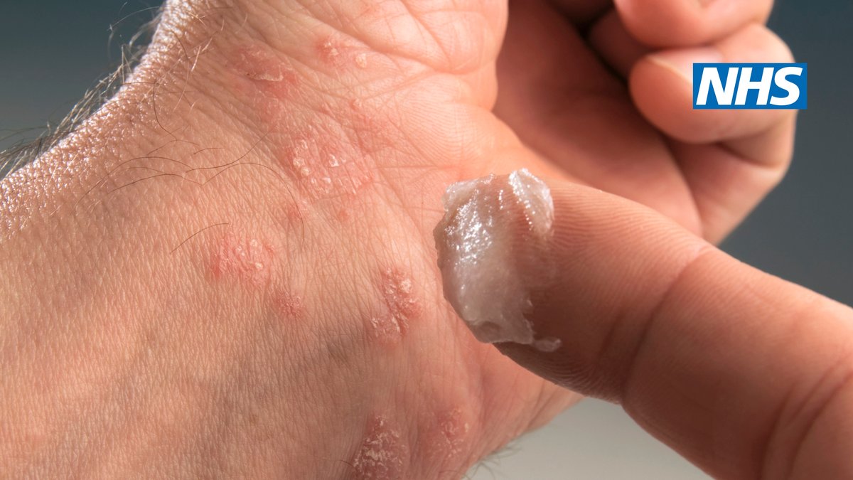 how to cure psoriasis permanently uk