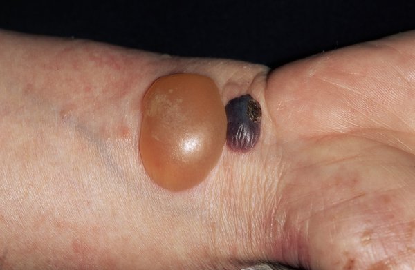 A large fluid-filled blister next to a smaller blood-filled blister on the wrist of a person with white skin.