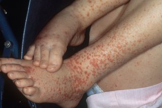 Henoch-Schonlein purpura on white skin. There's lots of small red spots and patches on a child's legs and feet.
