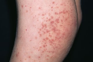 Rash of small red spots and patches on a child's knees.