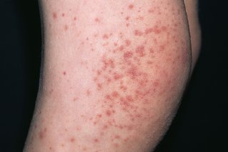 vascular rash