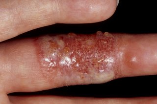 A finger with red lumps under the skin filled with fluid. Shown on white skin.