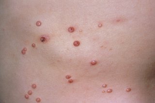 Image of MC spots, which are usually firm and dome-shaped, with a small dimple in the middle. They're usually less than 5mm (0.5cm) across, but can sometimes be bigger
