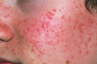 Picture of acne spots.