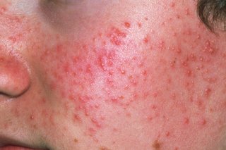 Picture of acne spots.