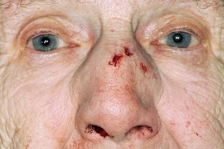 A person's face with several cuts on the bridge and side of their nose and a small nosebleed.